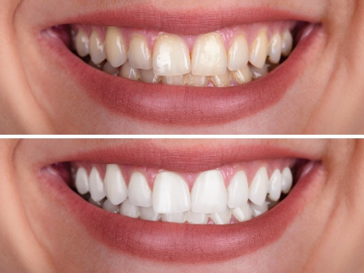Teeth whitening Simple Safe and Effective